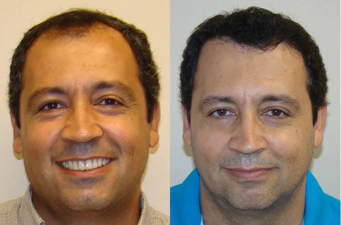 Valmir Hair Transplant Before and After