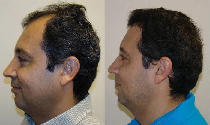 Patient p74 hair transplant before and after left view