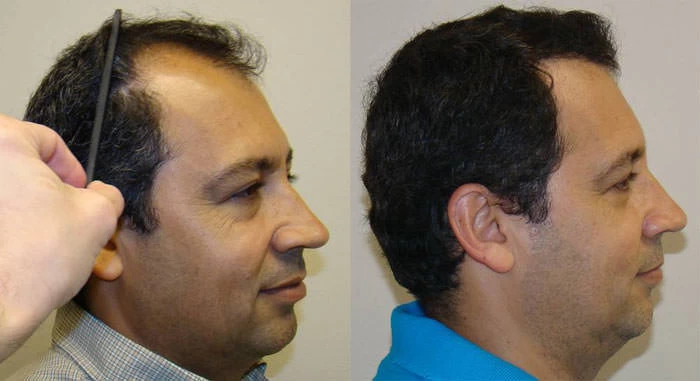 Patient p74 hair transplant before and after right view