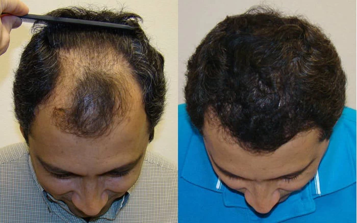 Patient p74 hair transplant before and after tilt view