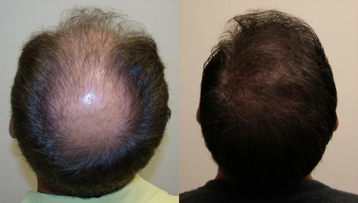 Patient p75 hair transplant before and after crown view