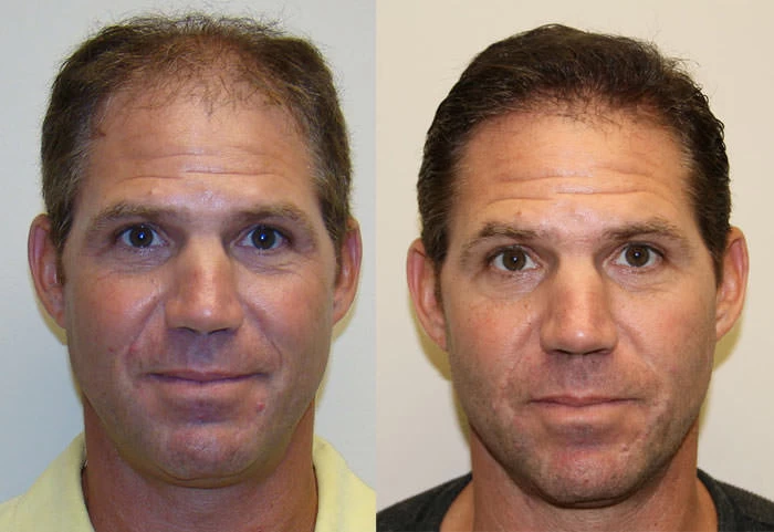 Vito Hair Transplant Before and After