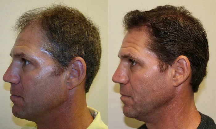 Patient p75 hair transplant before and after left view