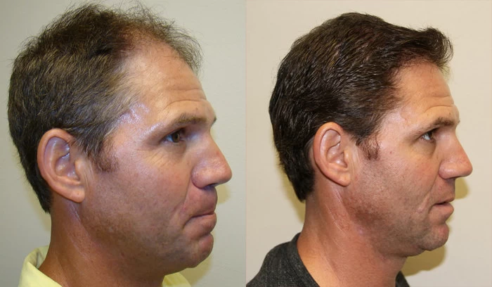 Patient p75 hair transplant before and after right view