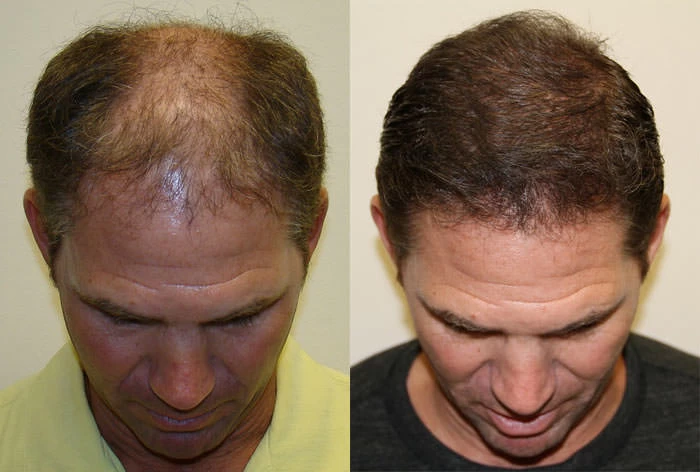 Patient p75 hair transplant before and after tilt view