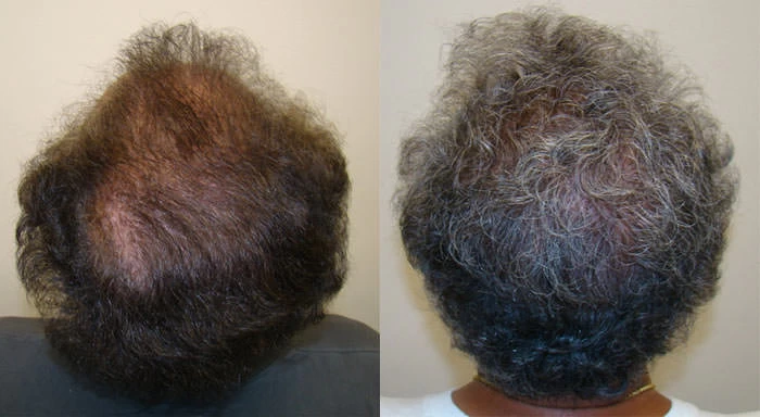 Patient p76 hair transplant before and after crown view