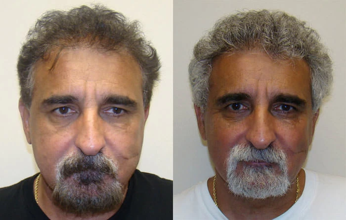 Albert Hair Transplant Before and After