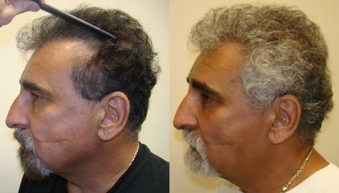 Patient p76 hair transplant before and after left view