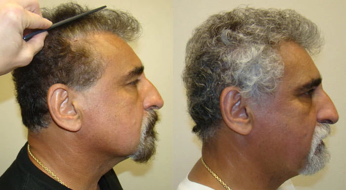 Patient p76 hair transplant before and after right view