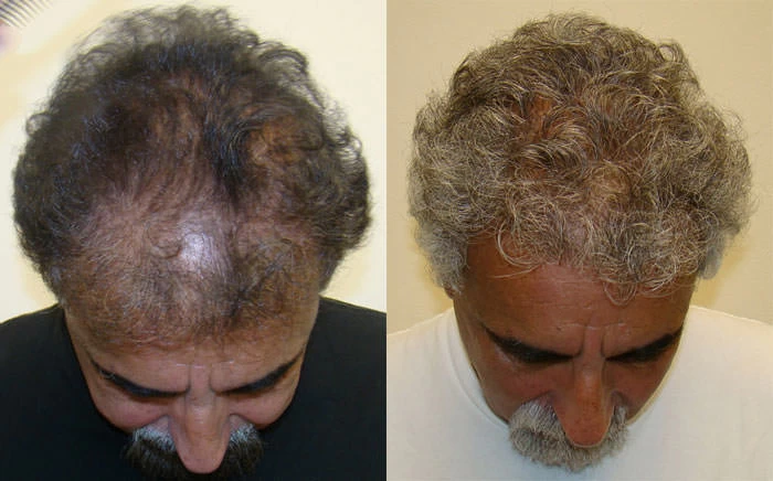 Patient p76 hair transplant before and after tilt view