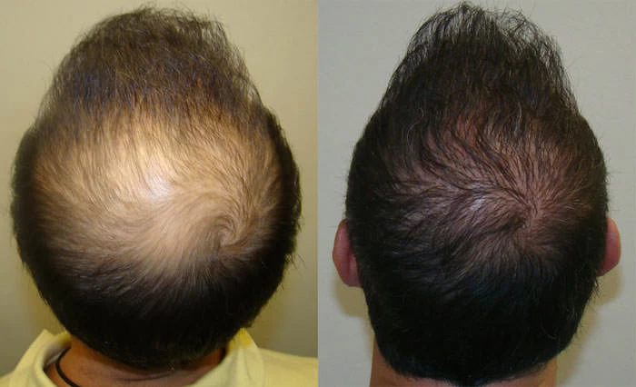 Patient p77 hair transplant before and after crown view