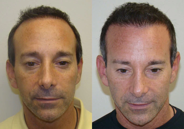 Patient 77 Hair Transplant Before and After