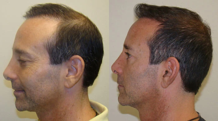 Patient p77 hair transplant before and after left view