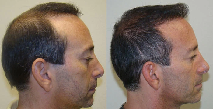 Patient p77 hair transplant before and after right view