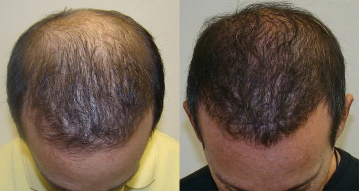 Patient p77 hair transplant before and after tilt view