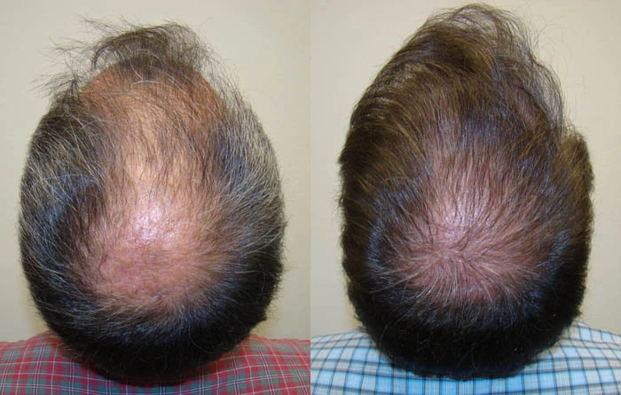 Patient p79 hair transplant before and after crown view