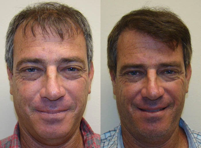 Steve Hair Transplant Before and After
