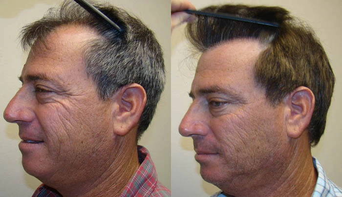 Patient p79 hair transplant before and after left view