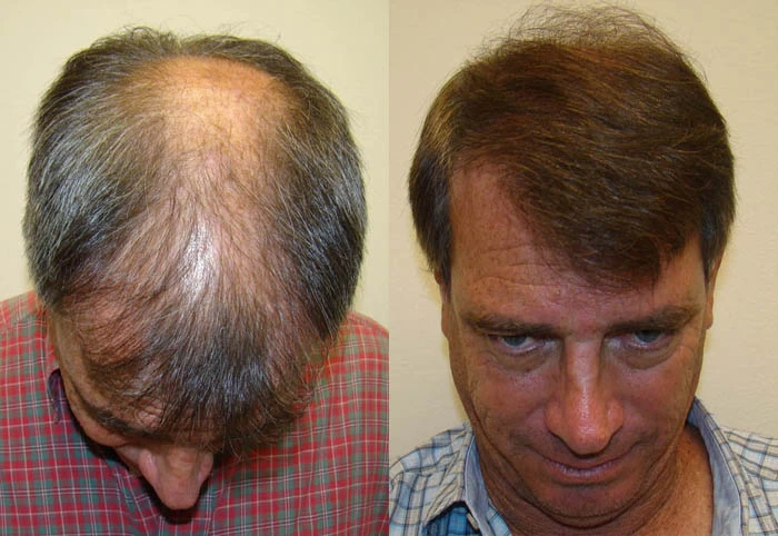 Patient p79 hair transplant before and after tilt view