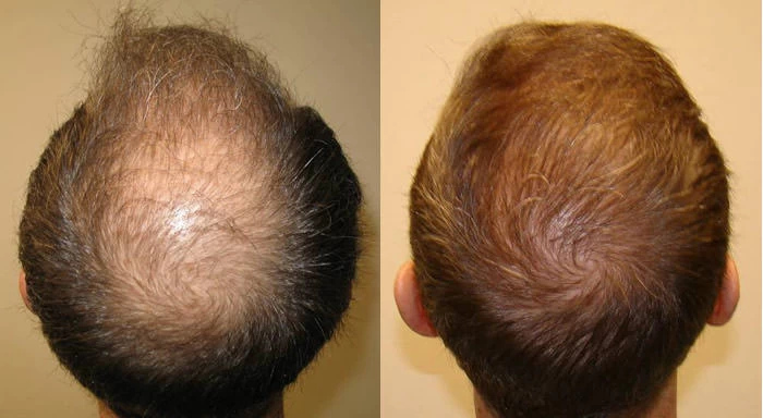 Patient p7 hair transplant before and after crown view