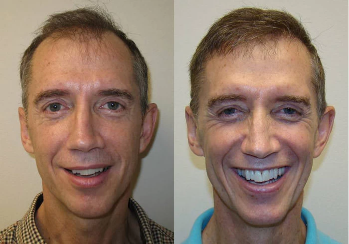 Greg Hair Transplant Before and After