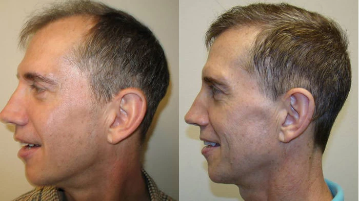 Patient p7 hair transplant before and after left view
