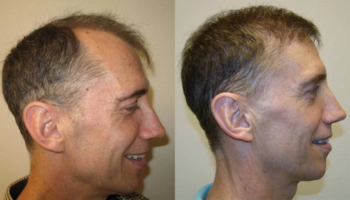 Patient p7 hair transplant before and after right view