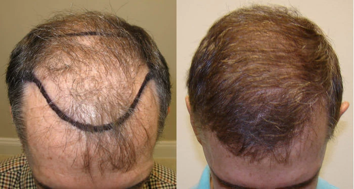 Patient p7 hair transplant before and after tilt view