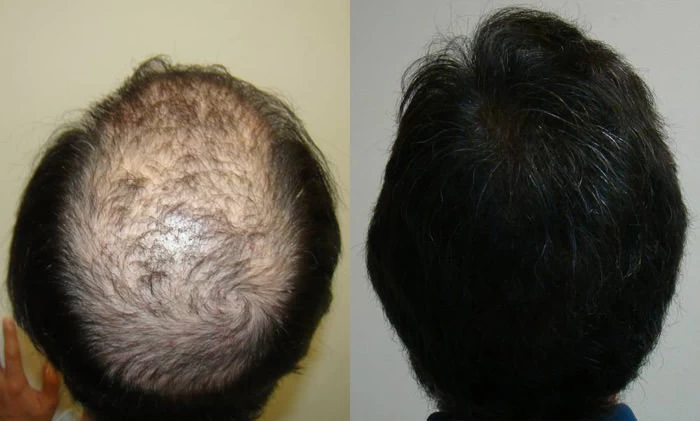 Patient p81 hair transplant before and after crown view