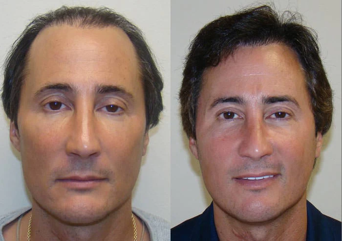 Patient 81 Hair Transplant Before and After