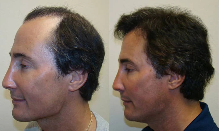 Patient p81 hair transplant before and after left view