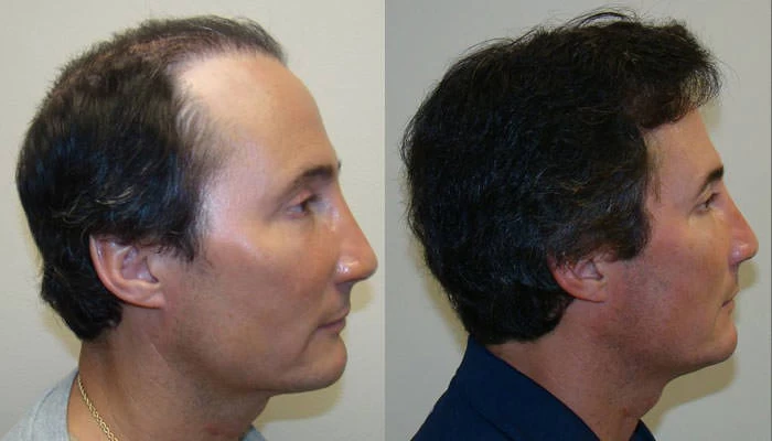 Patient p81 hair transplant before and after right view
