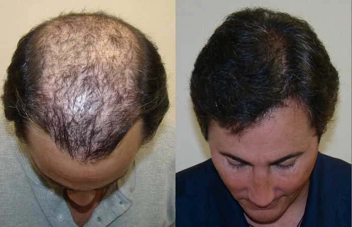 Patient p81 hair transplant before and after tilt view