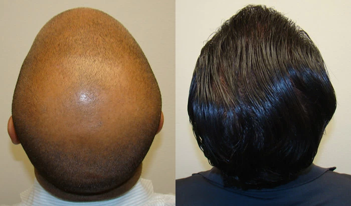 Patient p82 hair transplant before and after crown view