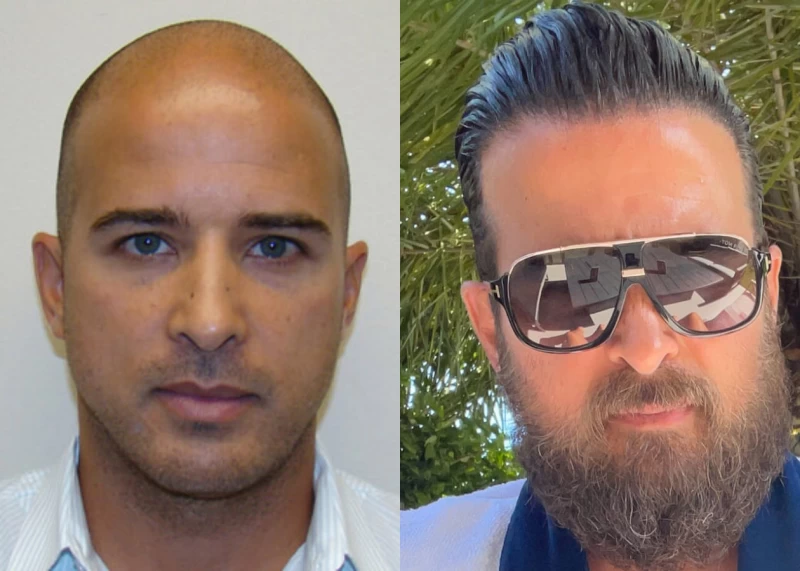 Aldo Hair Transplant Before and After