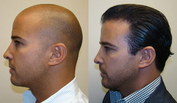 Patient p82 hair transplant before and after left view