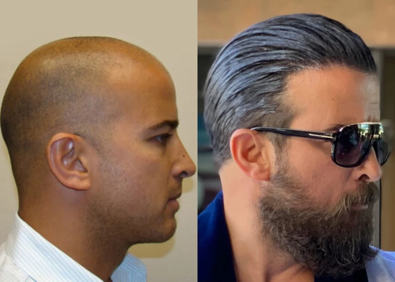 Patient p82 hair transplant before and after right view