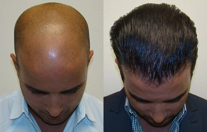 Patient p82 hair transplant before and after tilt view