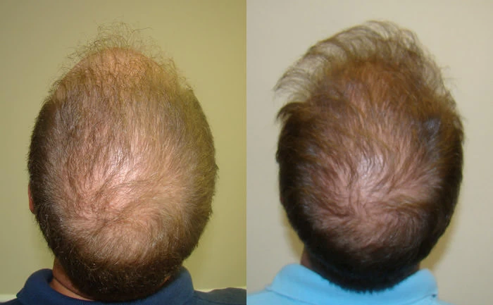 Patient p83 hair transplant before and after crown view