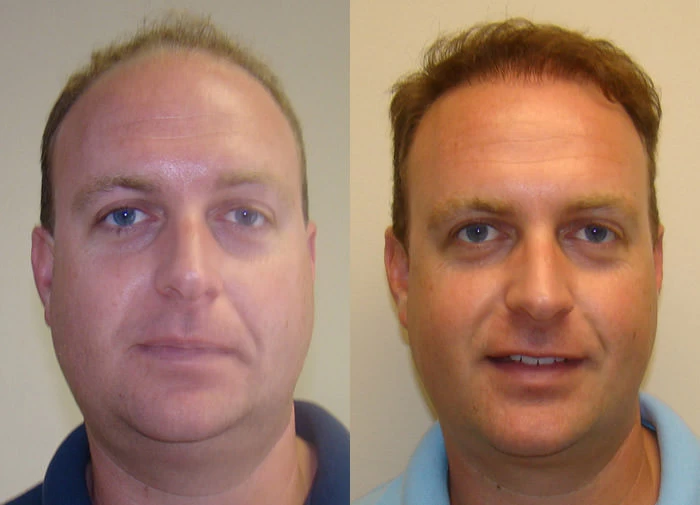Bobby Hair Transplant Before and After