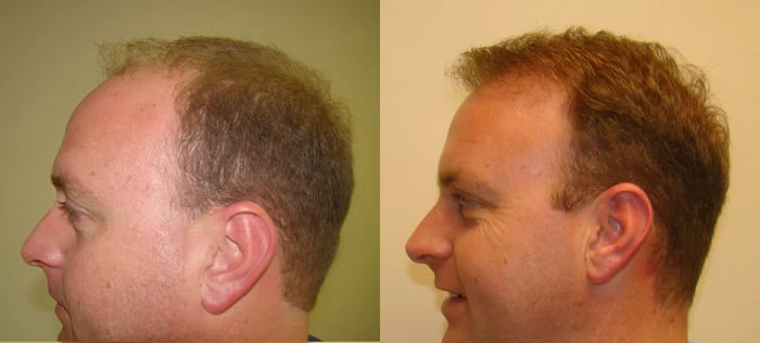 Patient p83 hair transplant before and after left view