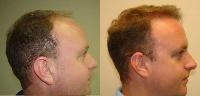 Patient p83 hair transplant before and after right view