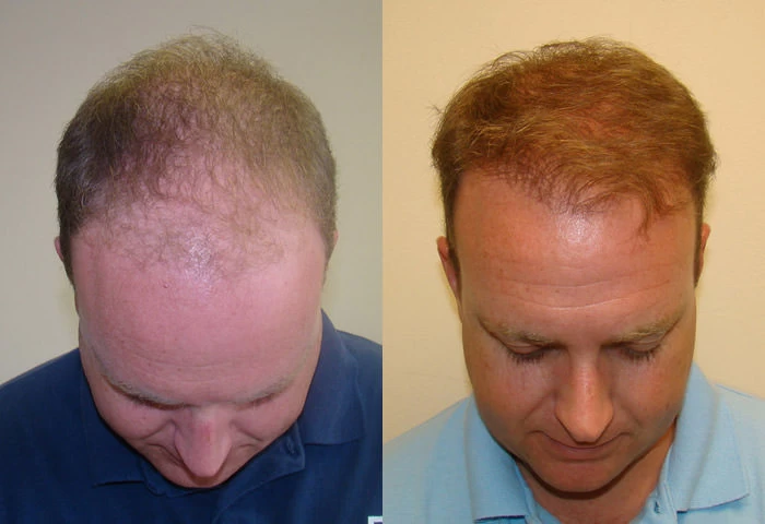 Patient p83 hair transplant before and after tilt view