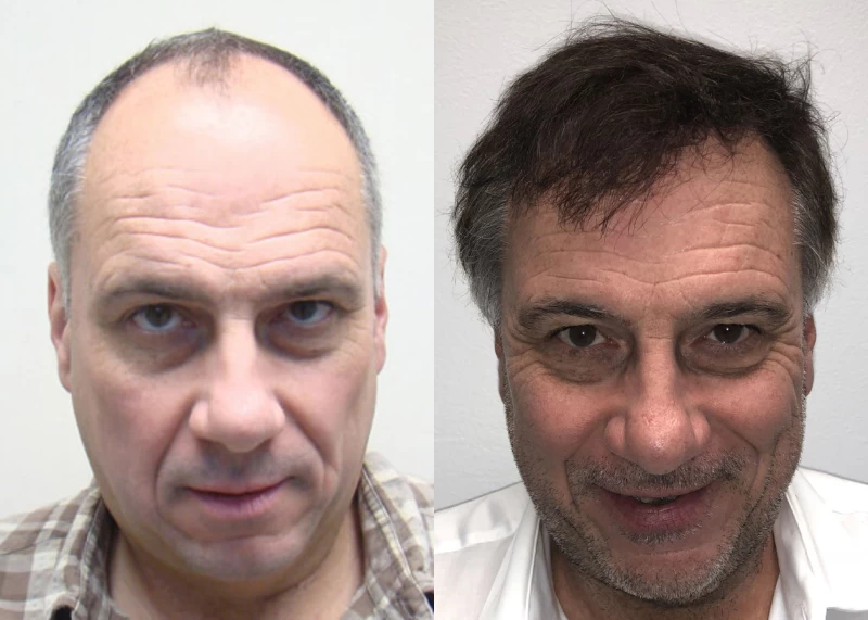 Glenn Hair Transplant Before and After