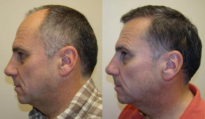 Patient p84 hair transplant before and after left view