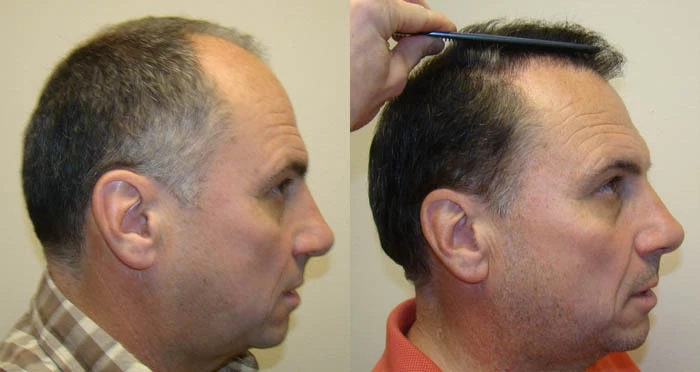 Patient p84 hair transplant before and after right view