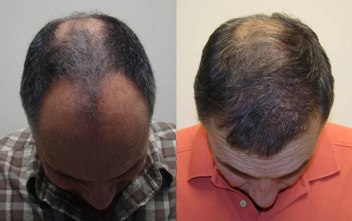 Patient p84 hair transplant before and after tilt view