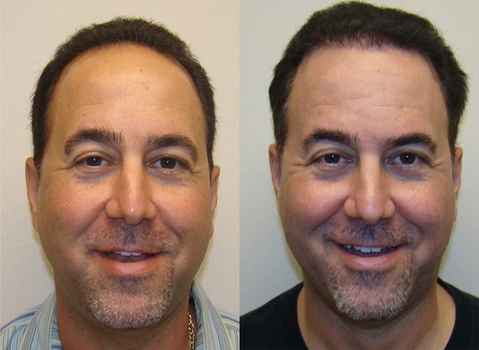 Jay Hair Transplant Before and After