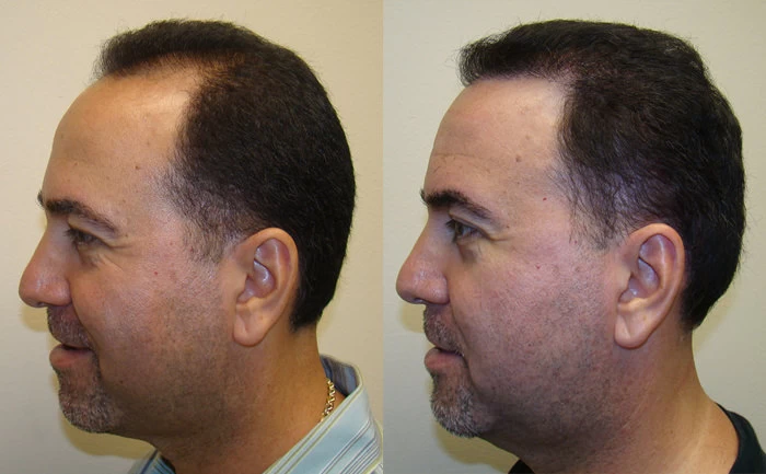 Patient p85 hair transplant before and after left view