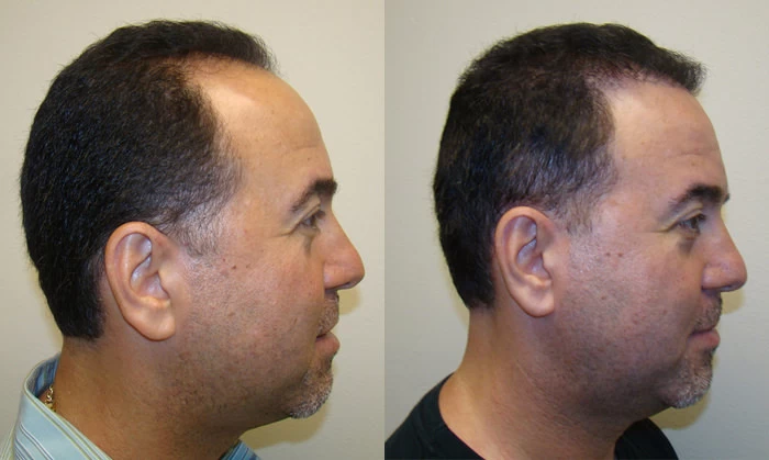Patient p85 hair transplant before and after right view